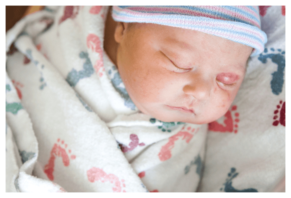 Young sleeping baby swaddled in printed blanket. She has eczema on her face.