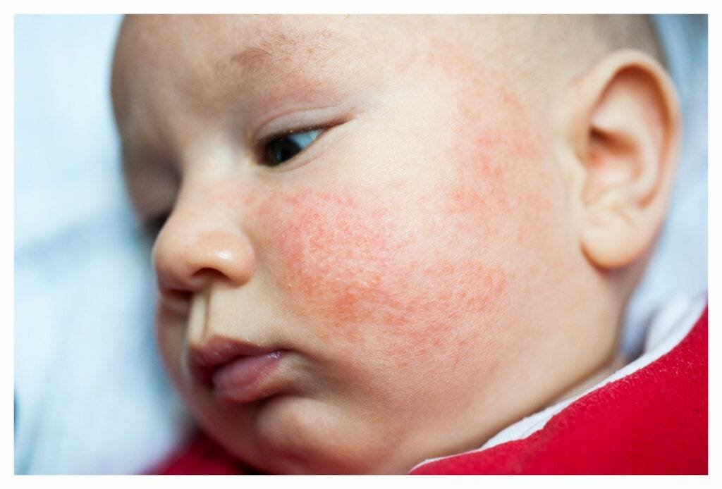 Asian baby with red baby eczema over his cheeks and forehead. The spots are not clearly defined and the skin between is inflamed