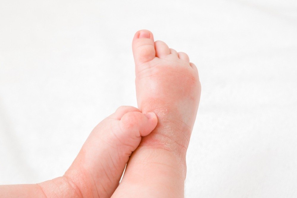 Close up of baby's legs and feet showing eczema patches and one foot scratching the other ankle.